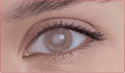 Mắt bị đục thuỷ tinh thể