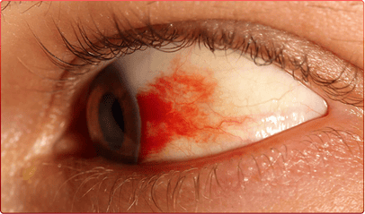 Mắt người bệnh bị bong võng mạc