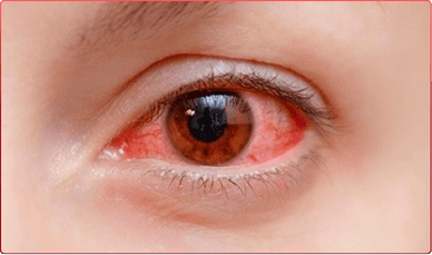 Mắt người bị thoái hóa điểm vàng